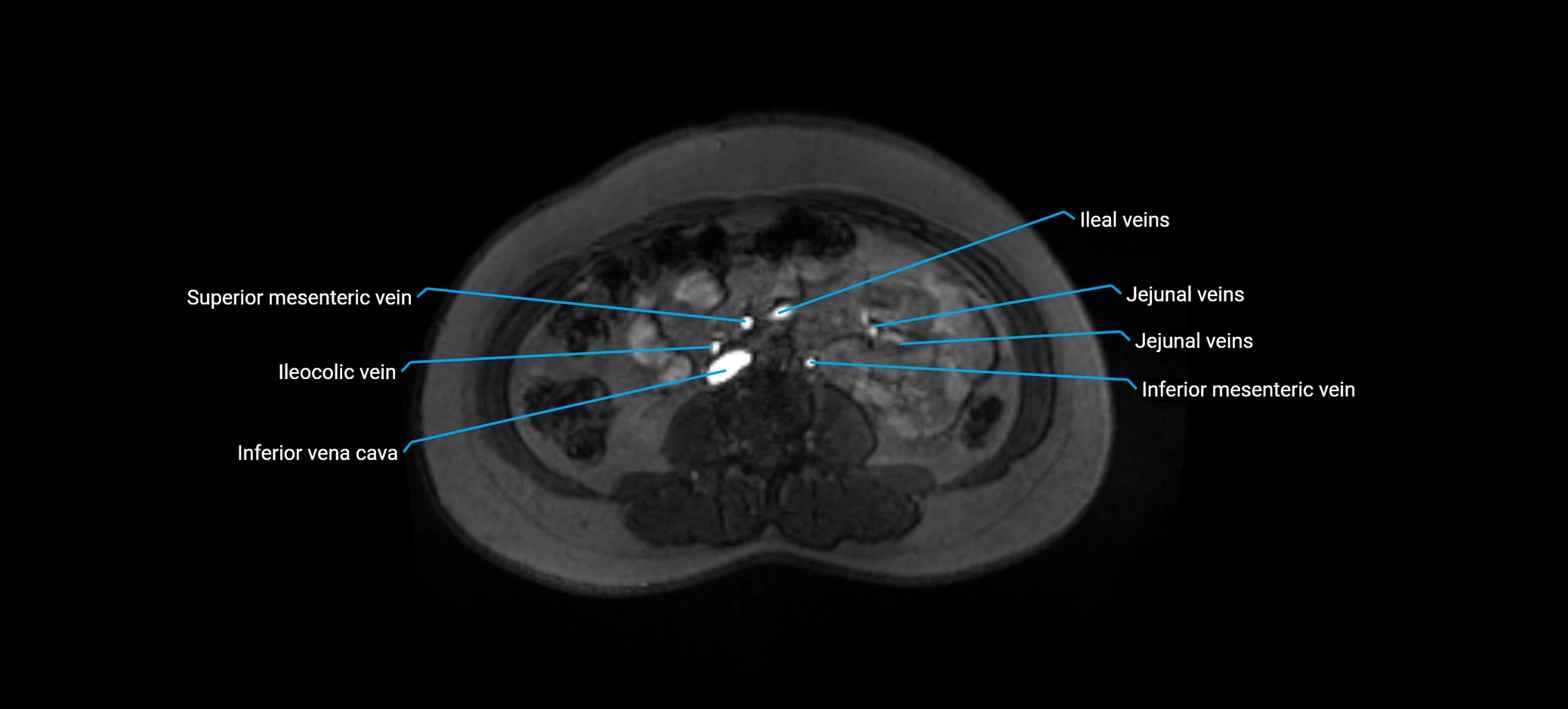 MRV abdomen pelvis & lower limb axial cross sectional anatomy labelled MRI image 94 (1).webp